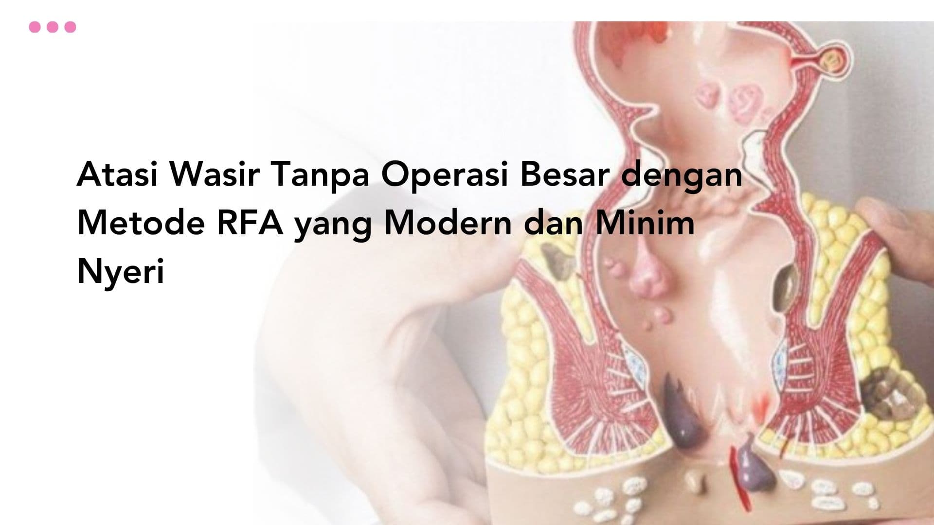Atasi Wasir Tanpa Operasi Besar dengan Metode RFA yang Modern dan Minim Nyeri
