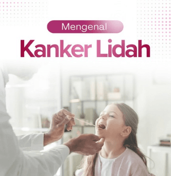 Kanker Lidah: Kenali Gejalanya, Penyebab, dan Faktor Risikonya
