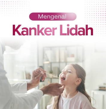 Kanker Lidah: Kenali Gejalanya, Penyebab, dan Faktor Risikonya
